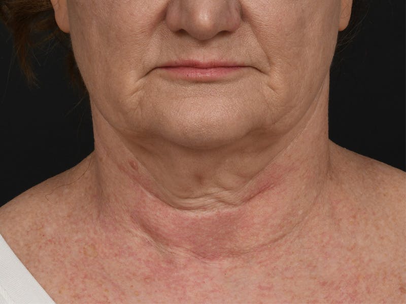 Neck Lift Before & After Gallery - Patient 408544 - Image 3