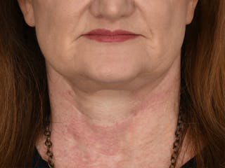 Neck Lift Before & After Gallery - Patient 408544 - Image 4