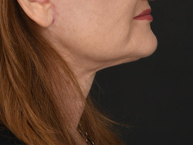 Neck Lift Before & After Gallery - Patient 408544 - Image 6