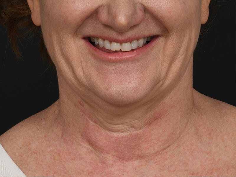Neck Lift Before & After Gallery - Patient 408544 - Image 7