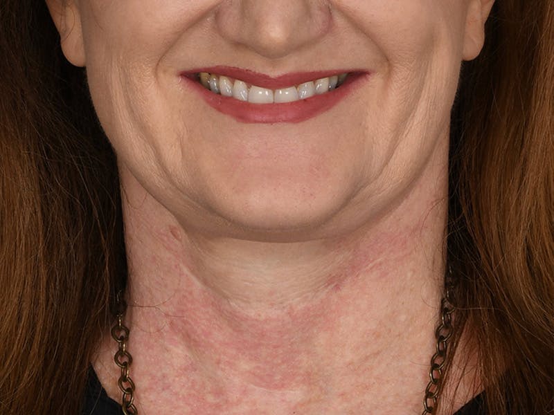 Neck Lift Before & After Gallery - Patient 408544 - Image 8