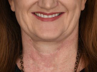 Neck Lift Before & After Gallery - Patient 408544 - Image 8