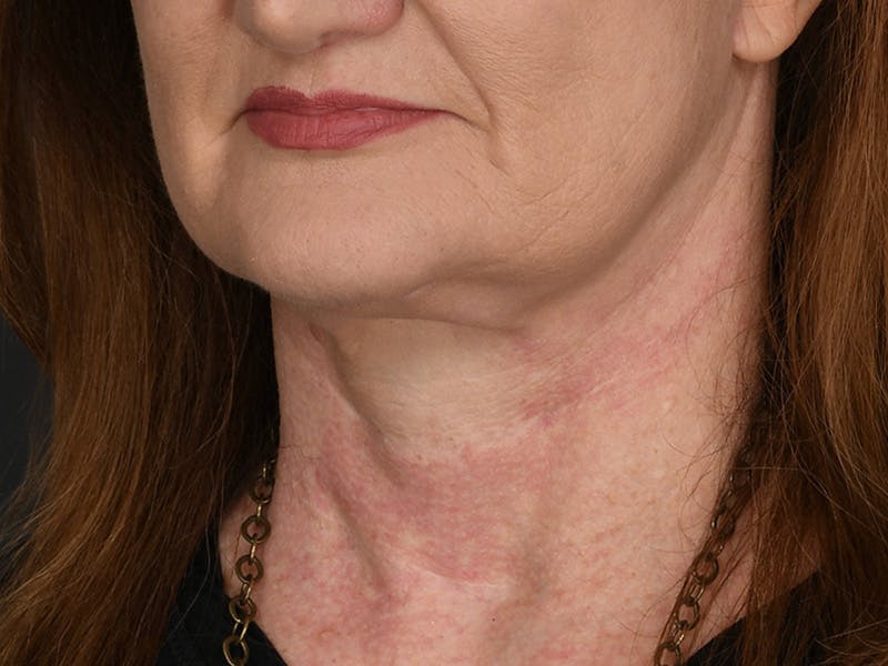Neck Lift Before & After Gallery - Patient 408544 - Image 10