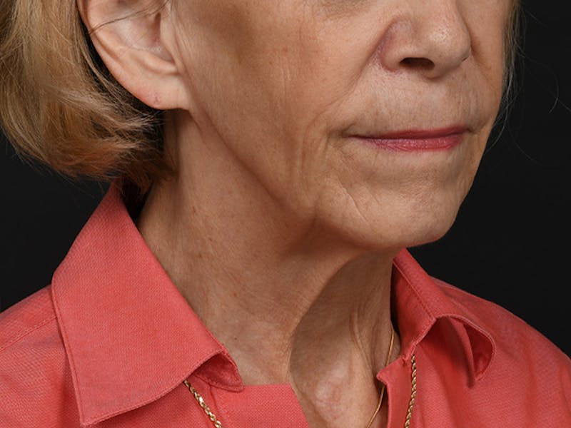 Neck Lift Before & After Gallery - Patient 120113 - Image 1