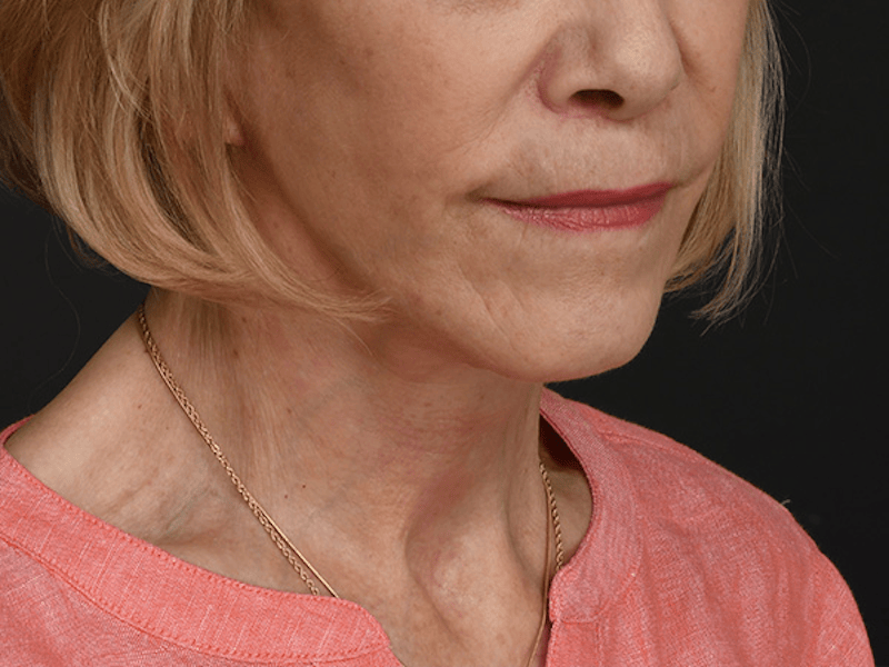 Neck Lift Before & After Gallery - Patient 120113 - Image 2