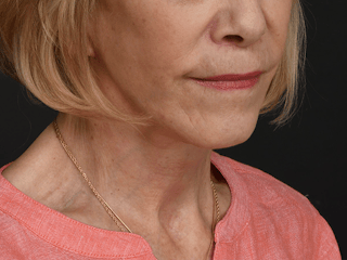 Neck Lift Before & After Gallery - Patient 120113 - Image 2