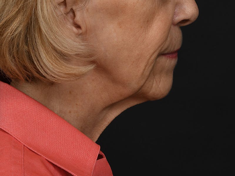 Neck Lift Before & After Gallery - Patient 120113 - Image 3