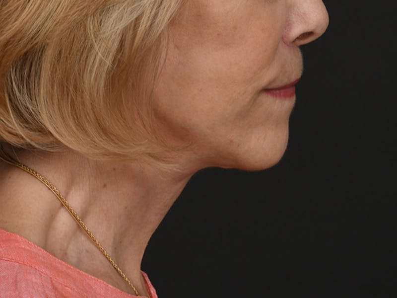 Neck Lift Before & After Gallery - Patient 120113 - Image 4