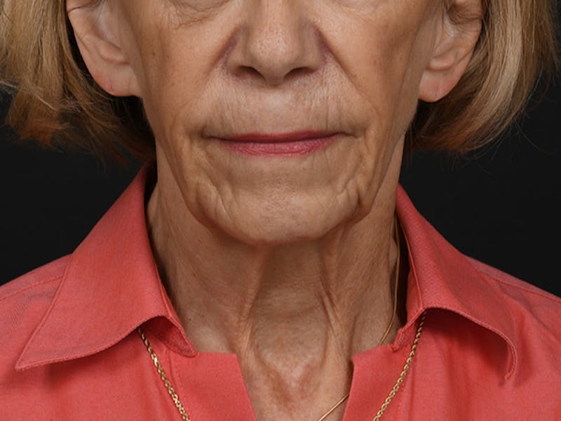 Neck Lift Before & After Gallery - Patient 120113 - Image 5