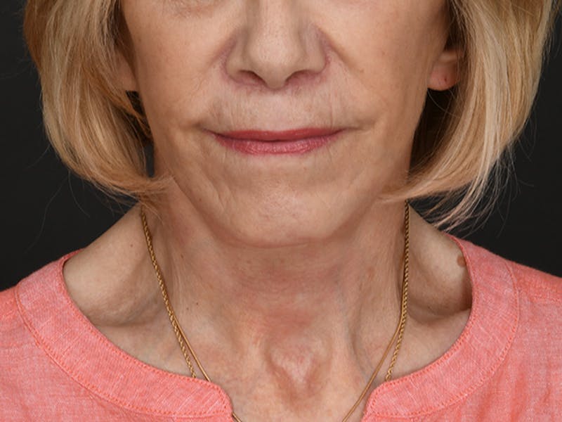 Neck Lift Before & After Gallery - Patient 120113 - Image 6