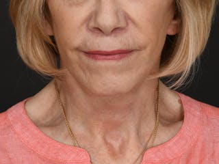 Neck Lift Before & After Gallery - Patient 120113 - Image 6