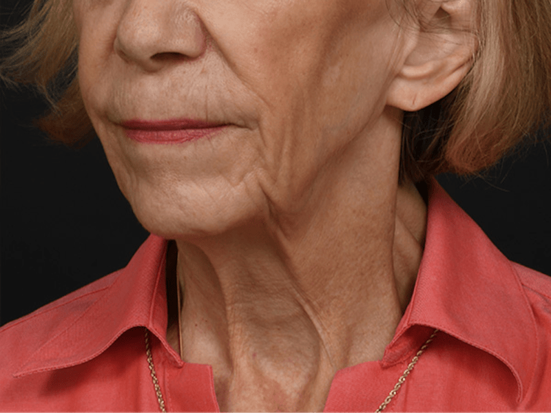 Neck Lift Before & After Gallery - Patient 120113 - Image 7