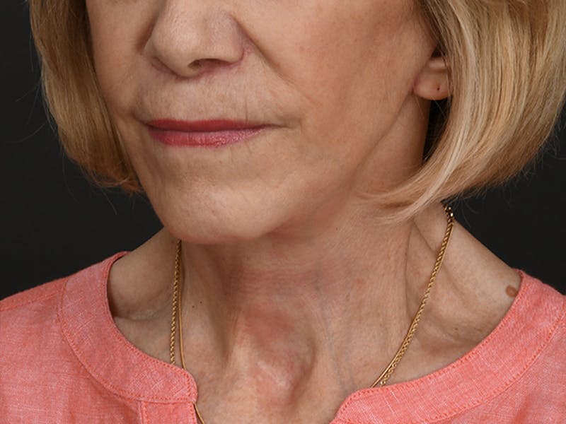 Neck Lift Before & After Gallery - Patient 120113 - Image 8