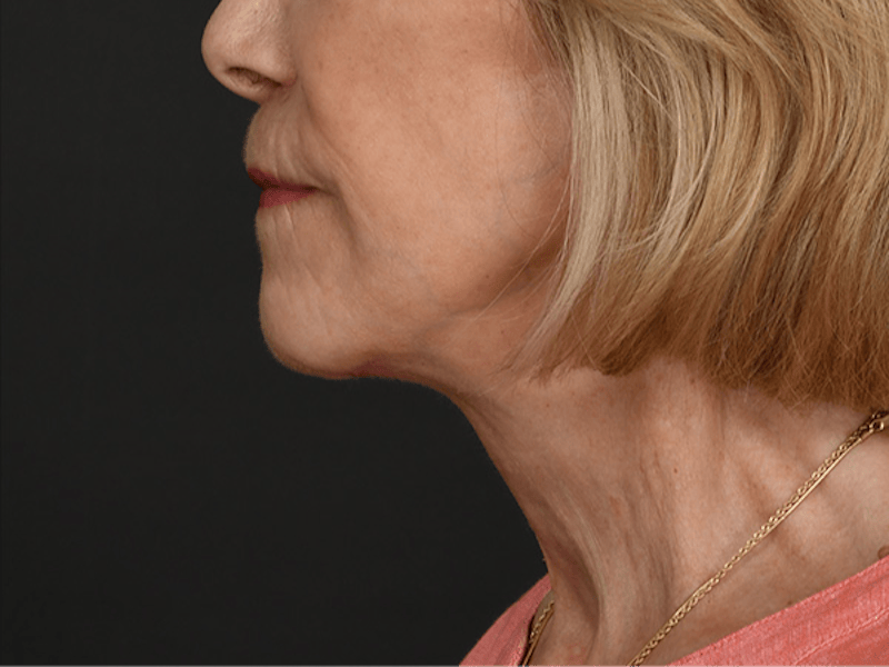 Neck Lift Before & After Gallery - Patient 120113 - Image 10