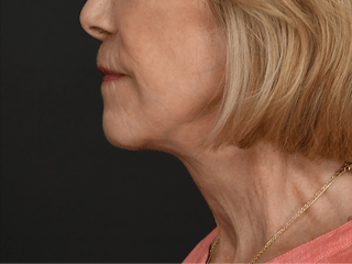 Neck Lift Before & After Gallery - Patient 120113 - Image 10