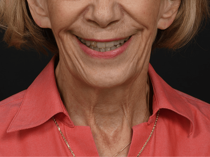 Neck Lift Before & After Gallery - Patient 120113 - Image 11