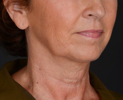 Neck Lift Before & After Gallery - Patient 325266 - Image 1