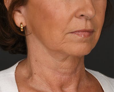 Neck Lift Before & After Gallery - Patient 325266 - Image 2