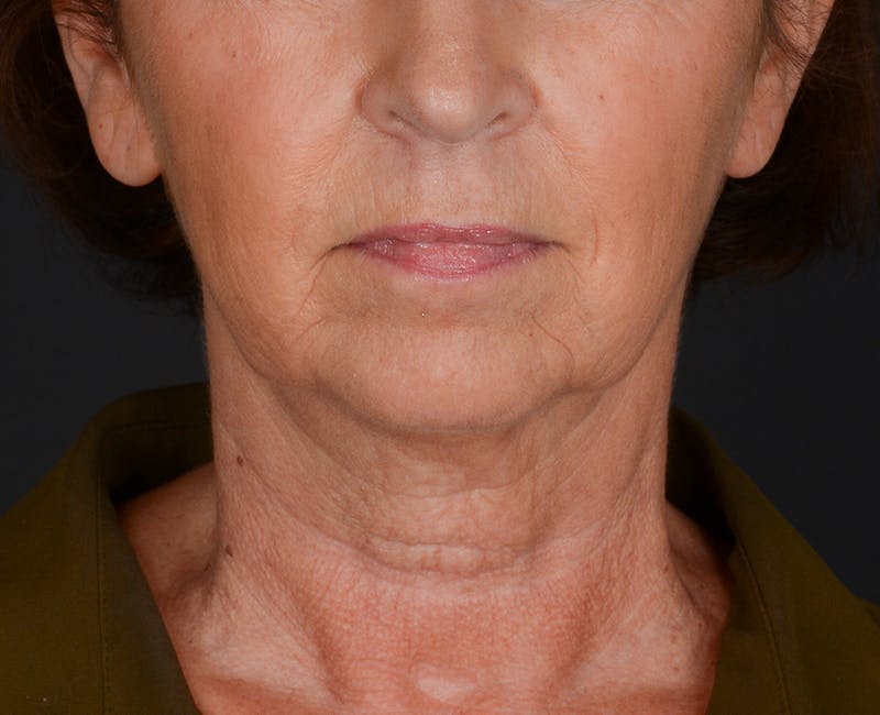 Neck Lift Before & After Gallery - Patient 325266 - Image 5