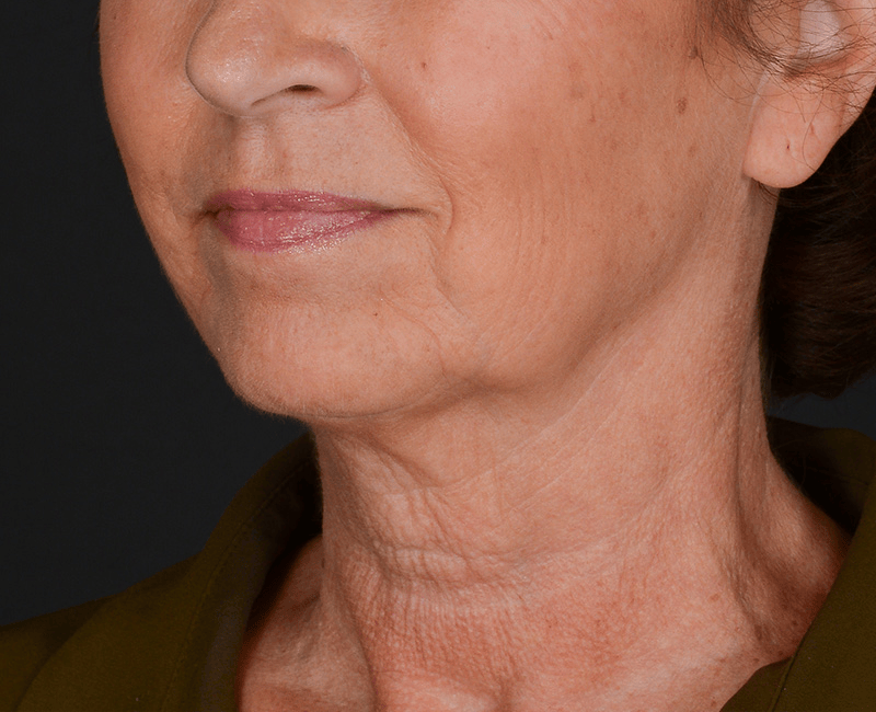 Neck Lift Before & After Gallery - Patient 325266 - Image 7