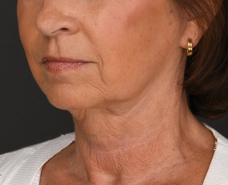 Neck Lift Before & After Gallery - Patient 325266 - Image 8