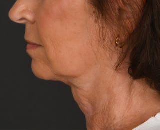 Neck Lift Before & After Gallery - Patient 325266 - Image 10