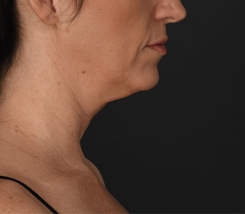 Neck Lift Before & After Gallery - Patient 158825 - Image 1
