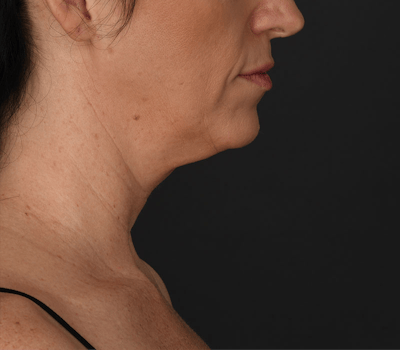 Neck Lift Before & After Gallery - Patient 158825 - Image 1
