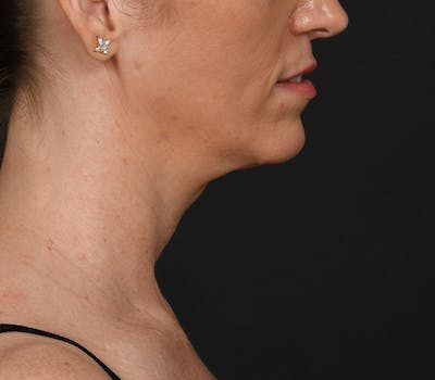 Neck Lift Before & After Gallery - Patient 158825 - Image 2