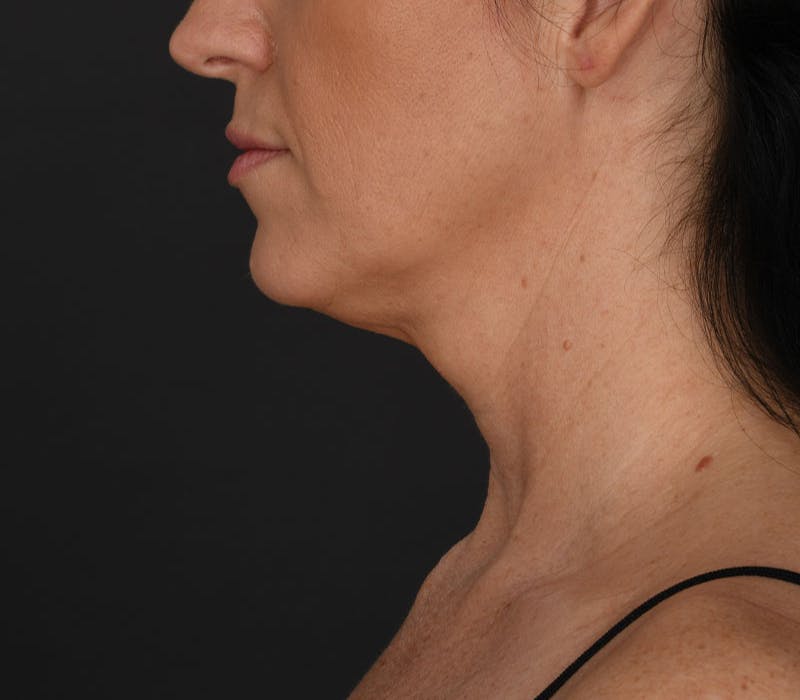 Neck Lift Before & After Gallery - Patient 158825 - Image 3