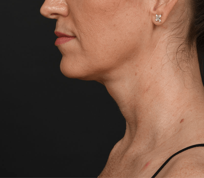 Neck Lift Before & After Gallery - Patient 158825 - Image 4