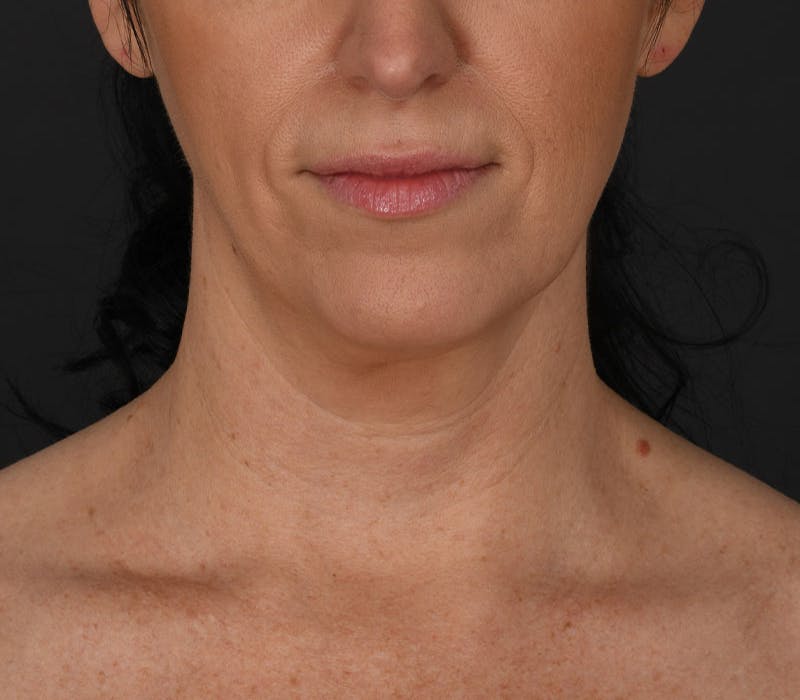 Neck Lift Before & After Gallery - Patient 158825 - Image 5