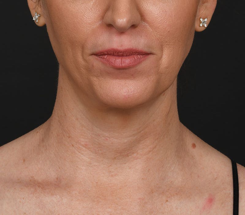 Neck Lift Before & After Gallery - Patient 158825 - Image 6