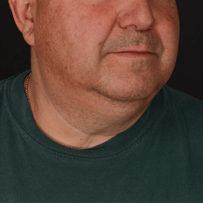 Neck Lift Before & After Gallery - Patient 282804 - Image 1