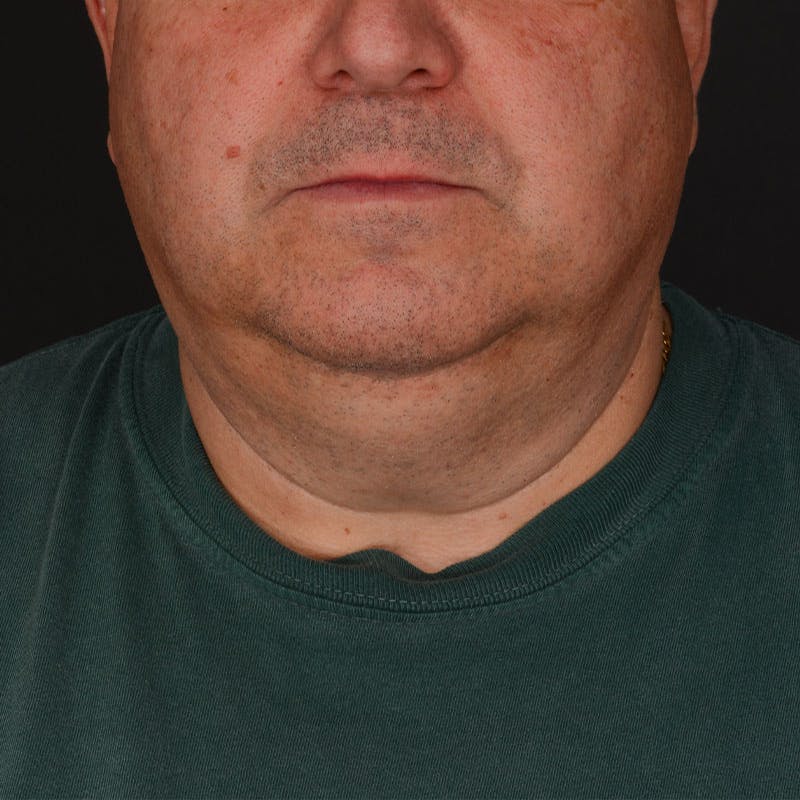 Neck Lift Before & After Gallery - Patient 282804 - Image 3