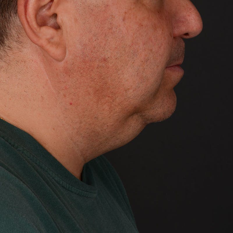 Neck Lift Before & After Gallery - Patient 282804 - Image 5
