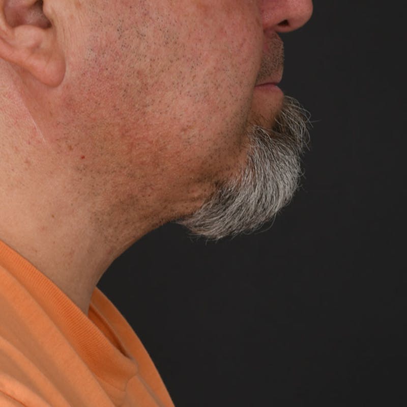 Neck Lift Before & After Gallery - Patient 282804 - Image 6