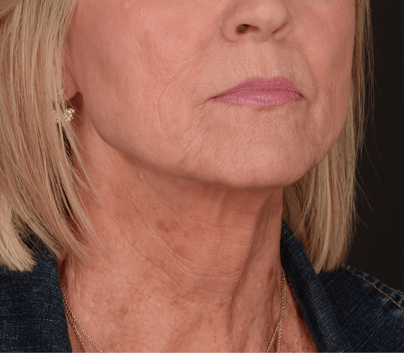 Neck Lift Before & After Gallery - Patient 110930 - Image 1