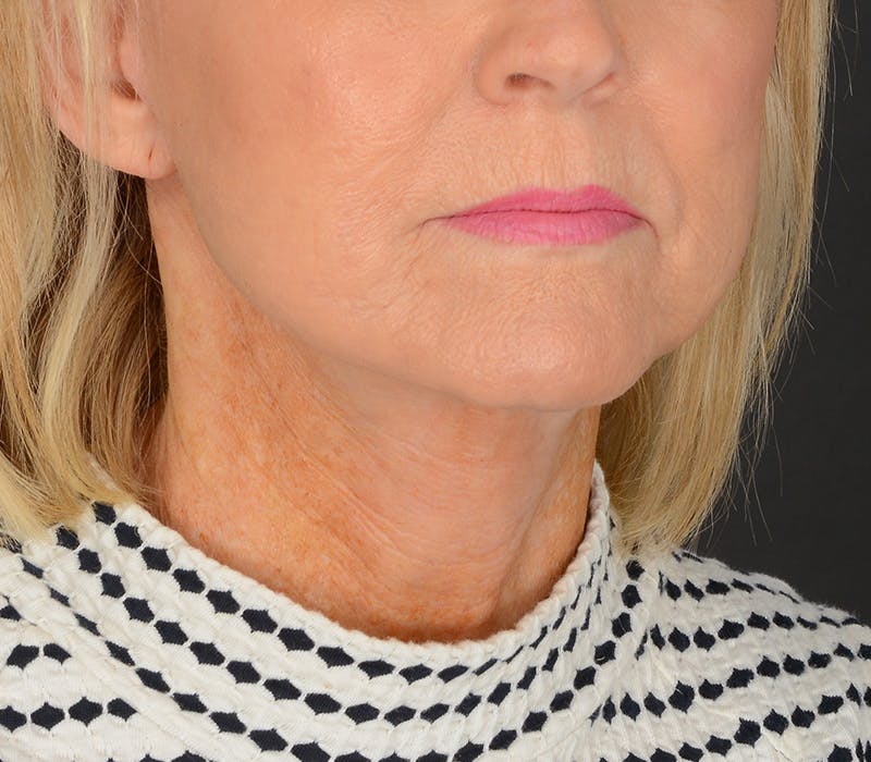 Neck Lift Before & After Gallery - Patient 110930 - Image 2
