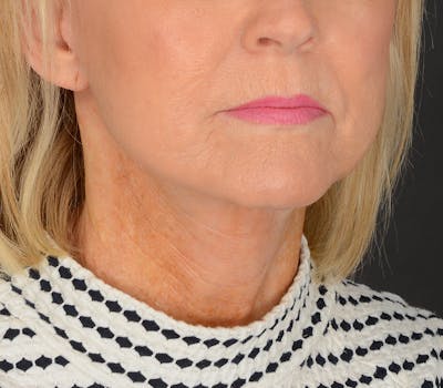 Neck Lift Before & After Gallery - Patient 110930 - Image 2