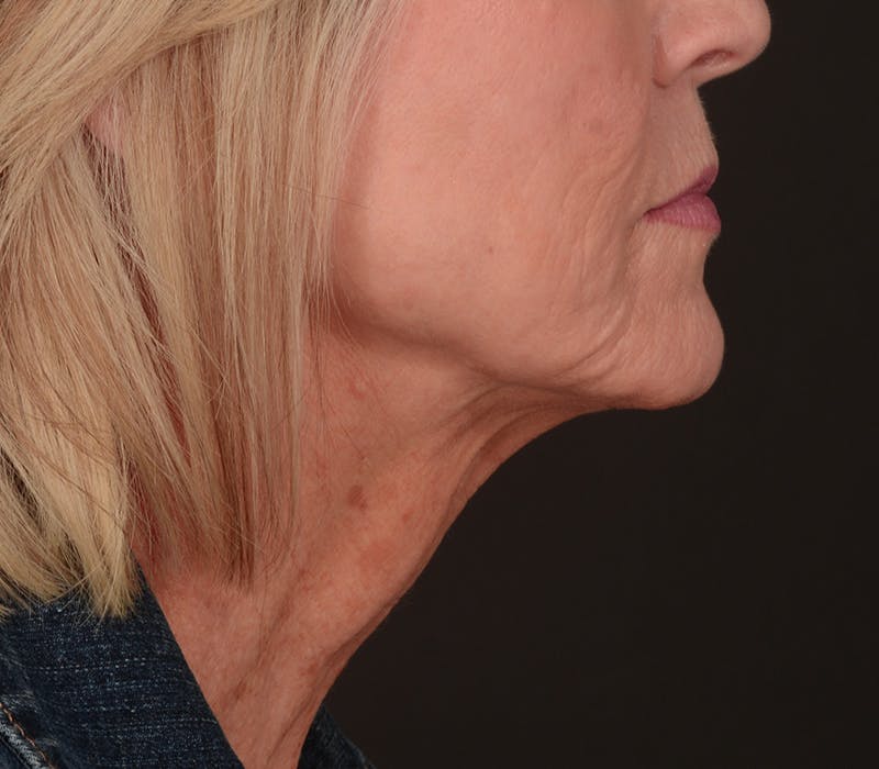 Neck Lift Before & After Gallery - Patient 110930 - Image 3