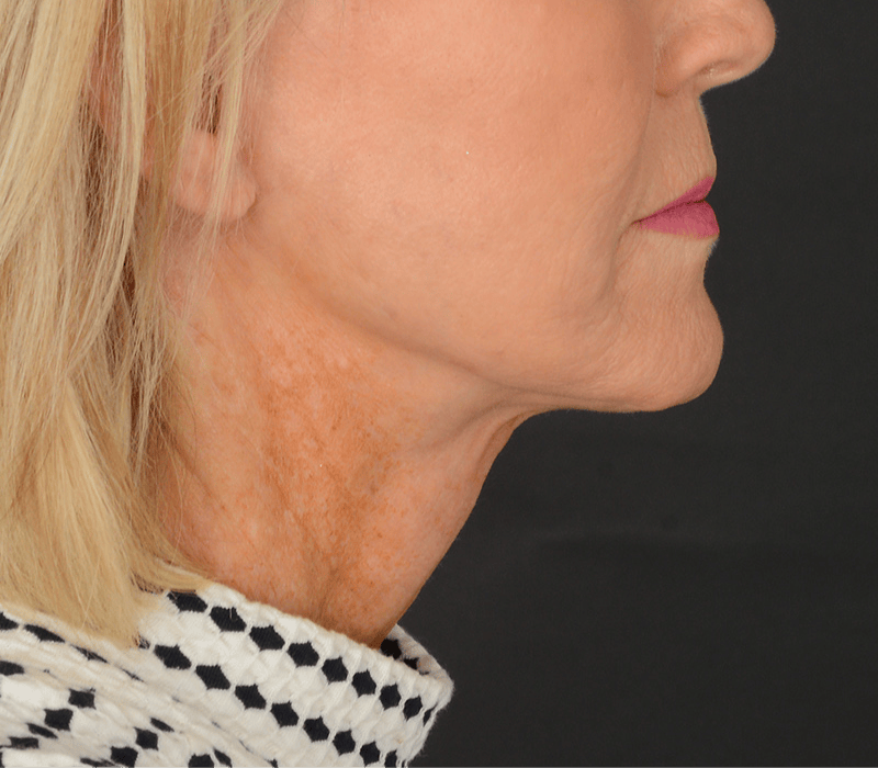 Neck Lift Before & After Gallery - Patient 110930 - Image 4