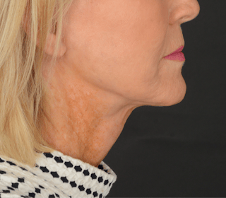 Neck Lift Before & After Gallery - Patient 110930 - Image 4