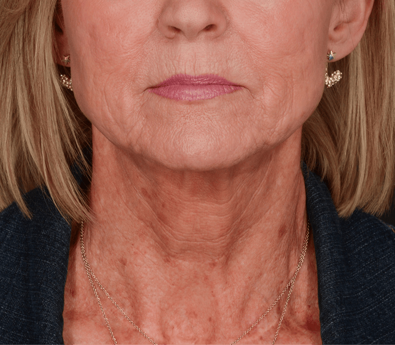 Neck Lift Before & After Gallery - Patient 110930 - Image 5