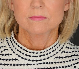 Neck Lift Before & After Gallery - Patient 110930 - Image 6