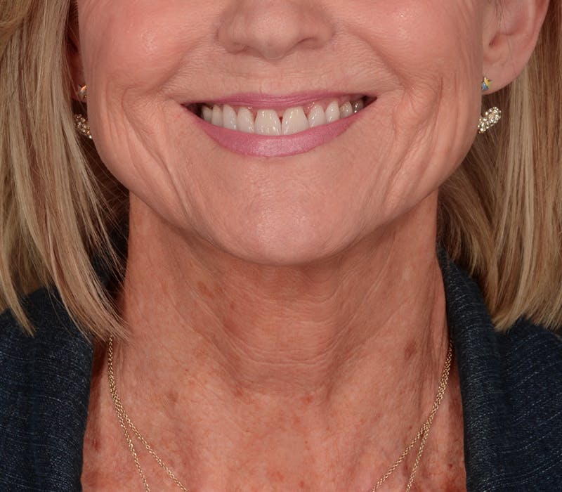 Neck Lift Before & After Gallery - Patient 110930 - Image 7