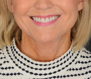 Neck Lift Before & After Gallery - Patient 110930 - Image 8