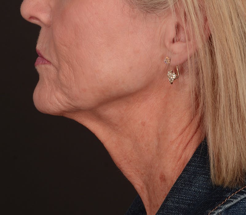 Neck Lift Before & After Gallery - Patient 110930 - Image 11