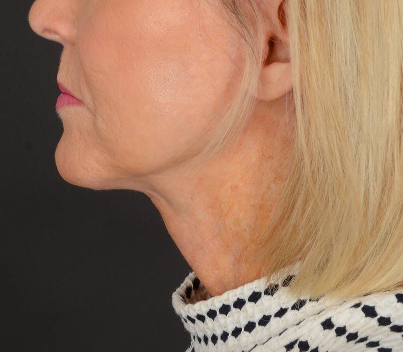 Neck Lift Before & After Gallery - Patient 110930 - Image 12