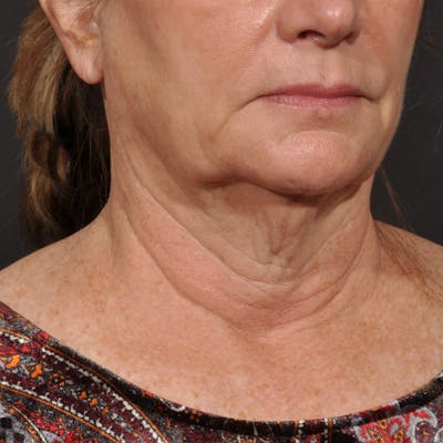 Neck Lift Before & After Gallery - Patient 428356 - Image 1